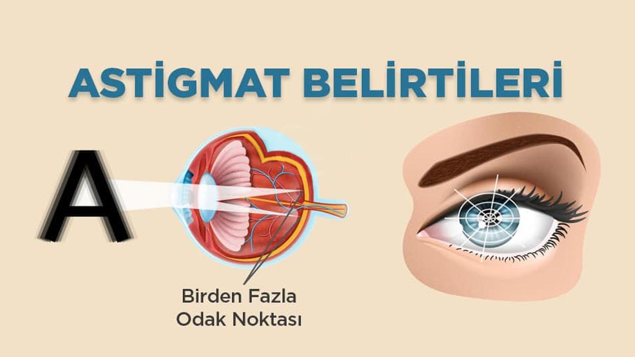 Astigmat genetik mi? Astigmat nasıl görür, tedavisi var mı?