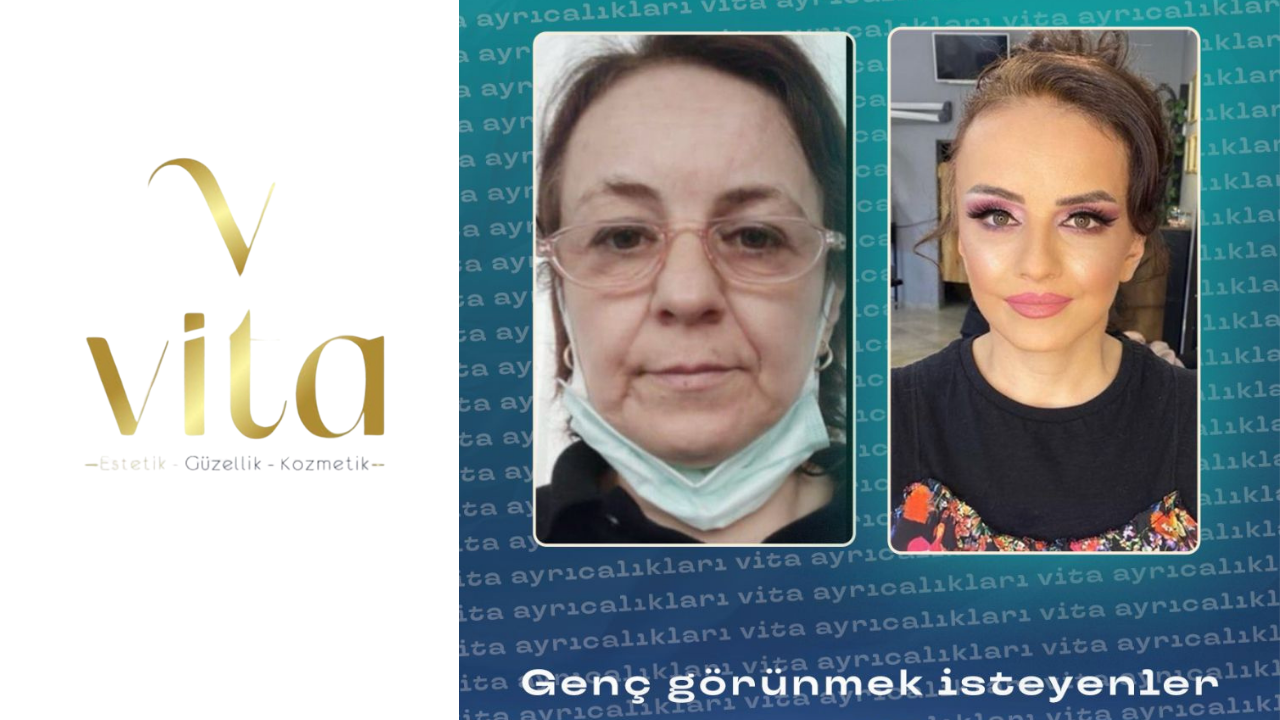 Estetik sonrası kendini tanımadı Hatice Hanım’ın 24 Yıllık Gençleşme Serüveni